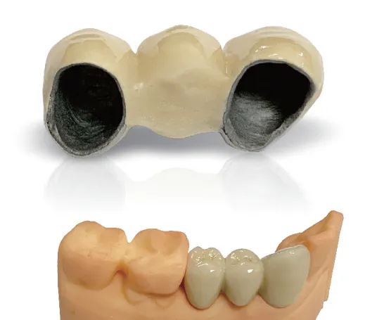 Fixed Restorations-PFM Crowns & Bridges