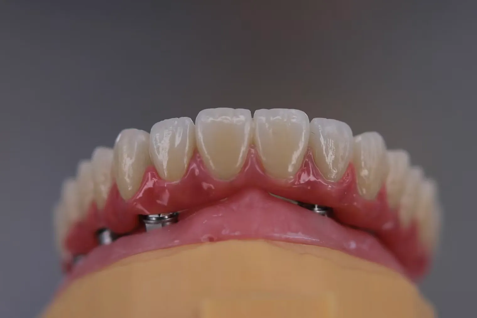 Implant‑Supported Restorations-Screw‑Retained Crowns & Bridges