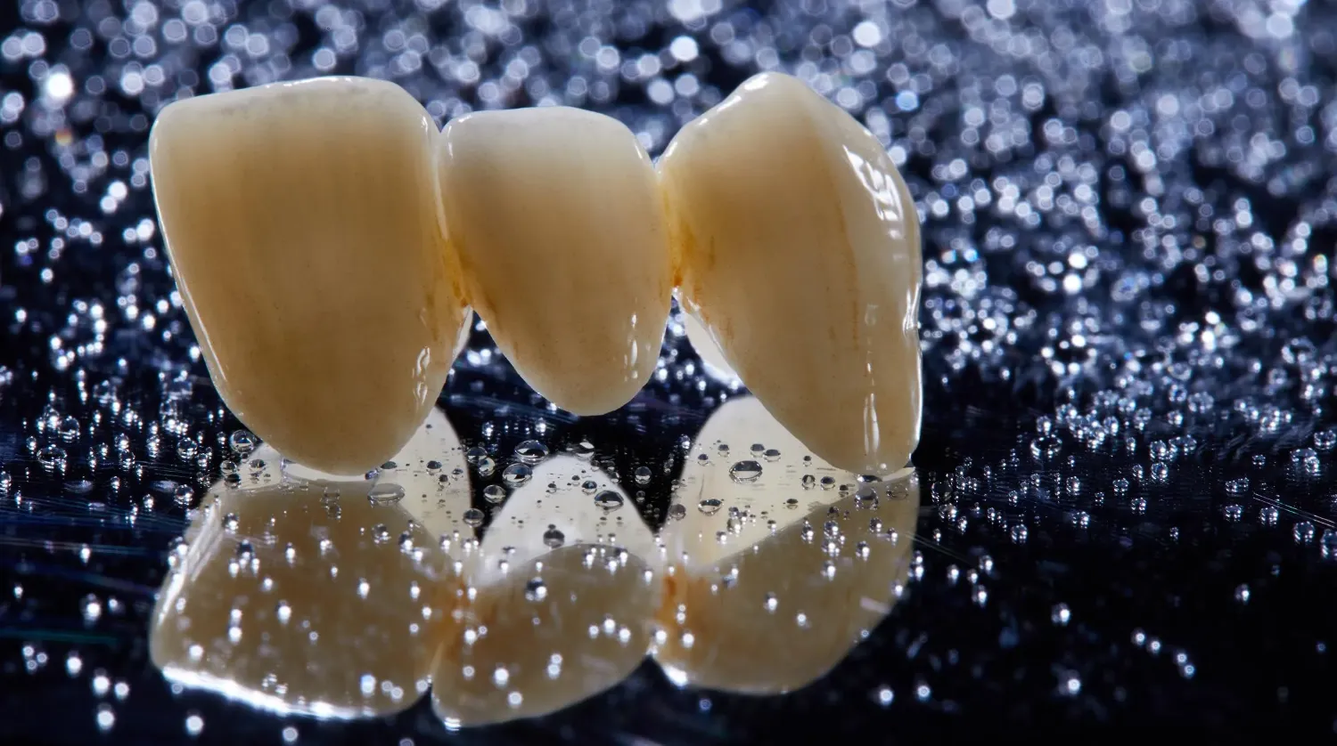 Fixed Restorations-Full‑Contour Zirconia Crowns