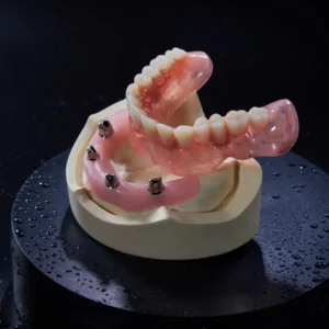 Implant‑Supported Restorations-Telescopic Crowns