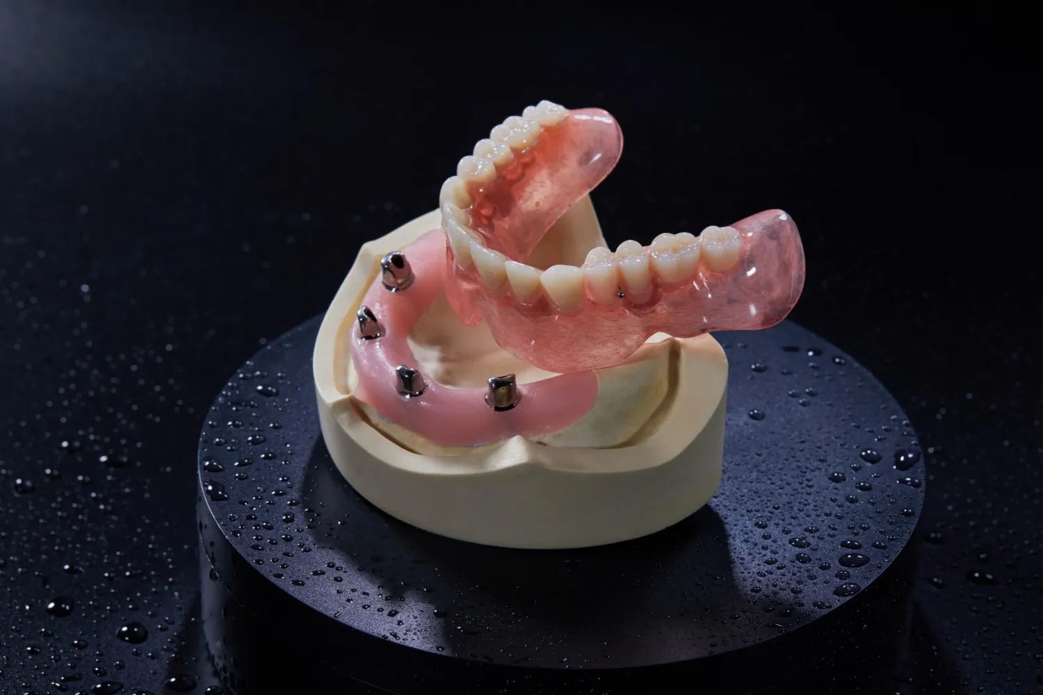 Implant‑Supported Restorations-Telescopic Crowns
