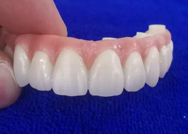 Fixed Restorations-Layered Zirconia