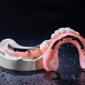 Implant‑Supported Restorations-Bar Overdentures