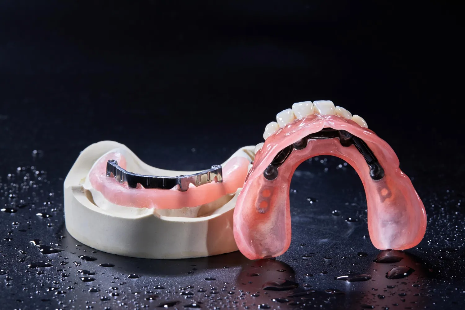 Implant‑Supported Restorations-Bar Overdentures