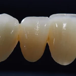 Fixed Restorations-Lithium Disilicate (E‑max)