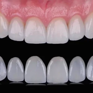 Fixed Restorations-Veneers