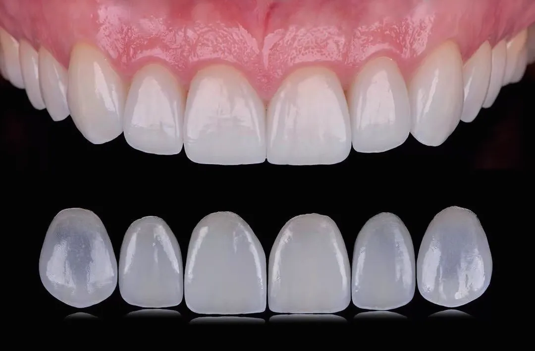 Fixed Restorations-Veneers