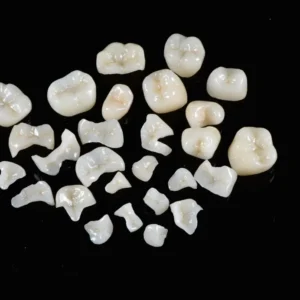 Fixed Restorations-Composite Inlay Onlay
